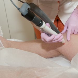 Laser Leg Vein Treatment (M22 & NDyag) Body Treatment