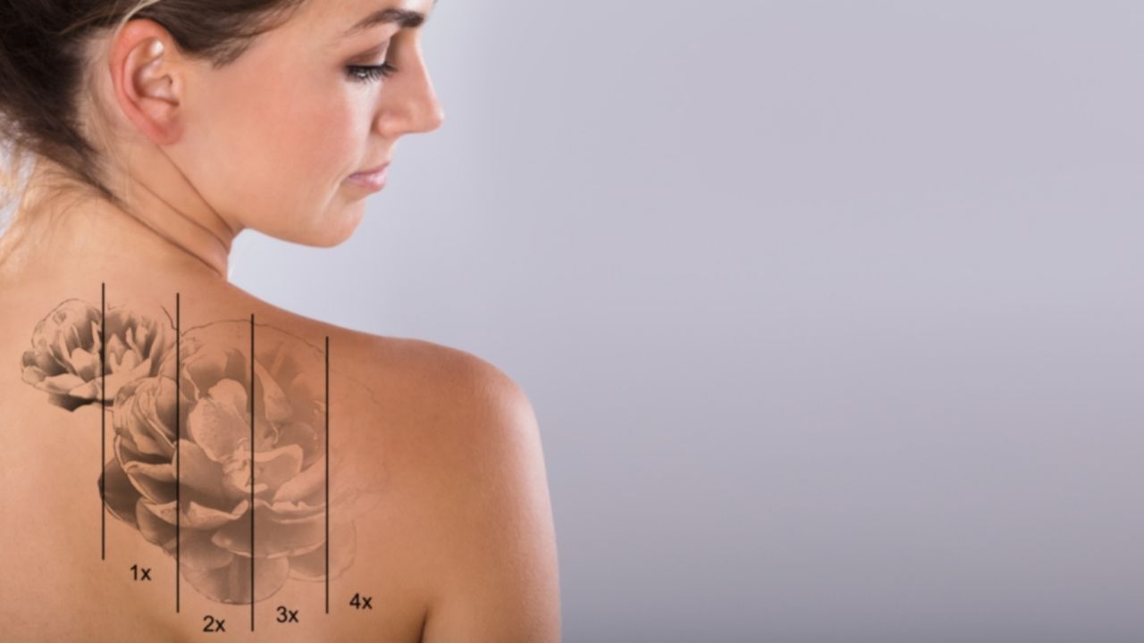 What Is Laser Tattoo Removal – And Does It Hurt? | Laser Hair Removal  Dublin Ireland | Havana Skin Clinic